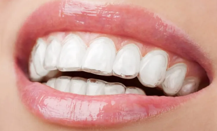 Invisalign clear aligners