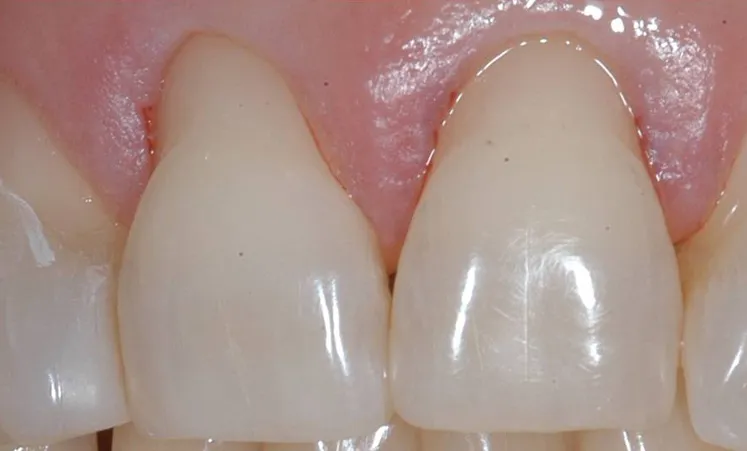 Progression of periodontal disease
