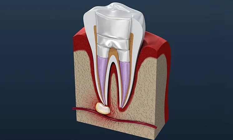 Root canal therapy procedure